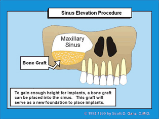 New Jersey Sinus Augmentation | NJ / Long Island Sinus Surgery