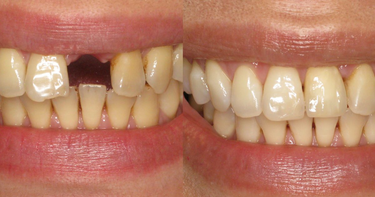 Front Tooth Replaced With Dental Implant - Advanced Periodontics ...