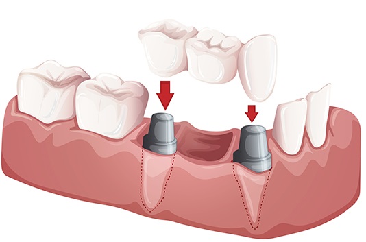 Illustration of Dental Bridges from Advanced Periodontics NYC