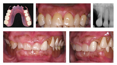 Images of dentures causing adjacent teeth to become loose 