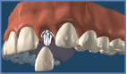 Smile in a Day Dental Implants