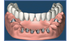 Smile in a Day Tooth Replacement