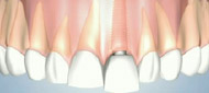 Dental Implant Fitting New York City