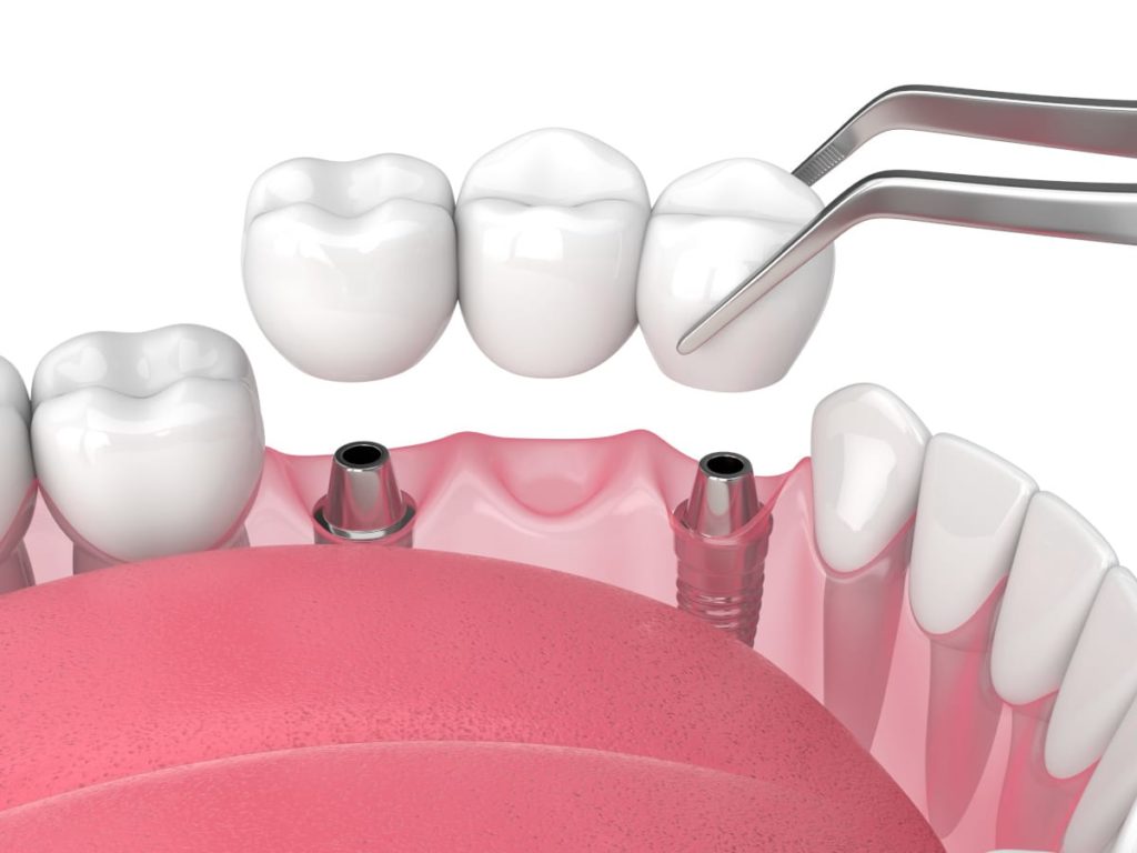 Fixed Dental Bridges