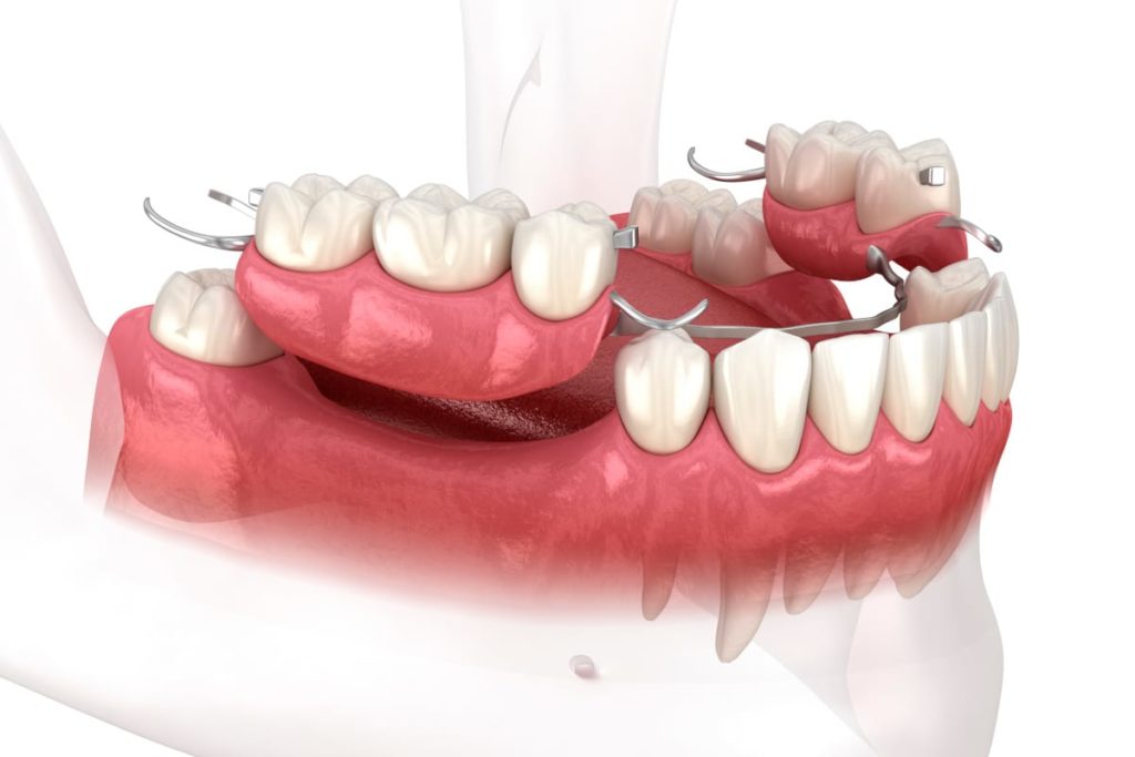 Removable Partial Dentures for Multiple Teeth