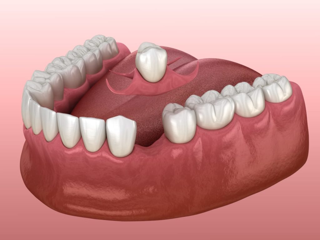 Replacing a single missing tooth