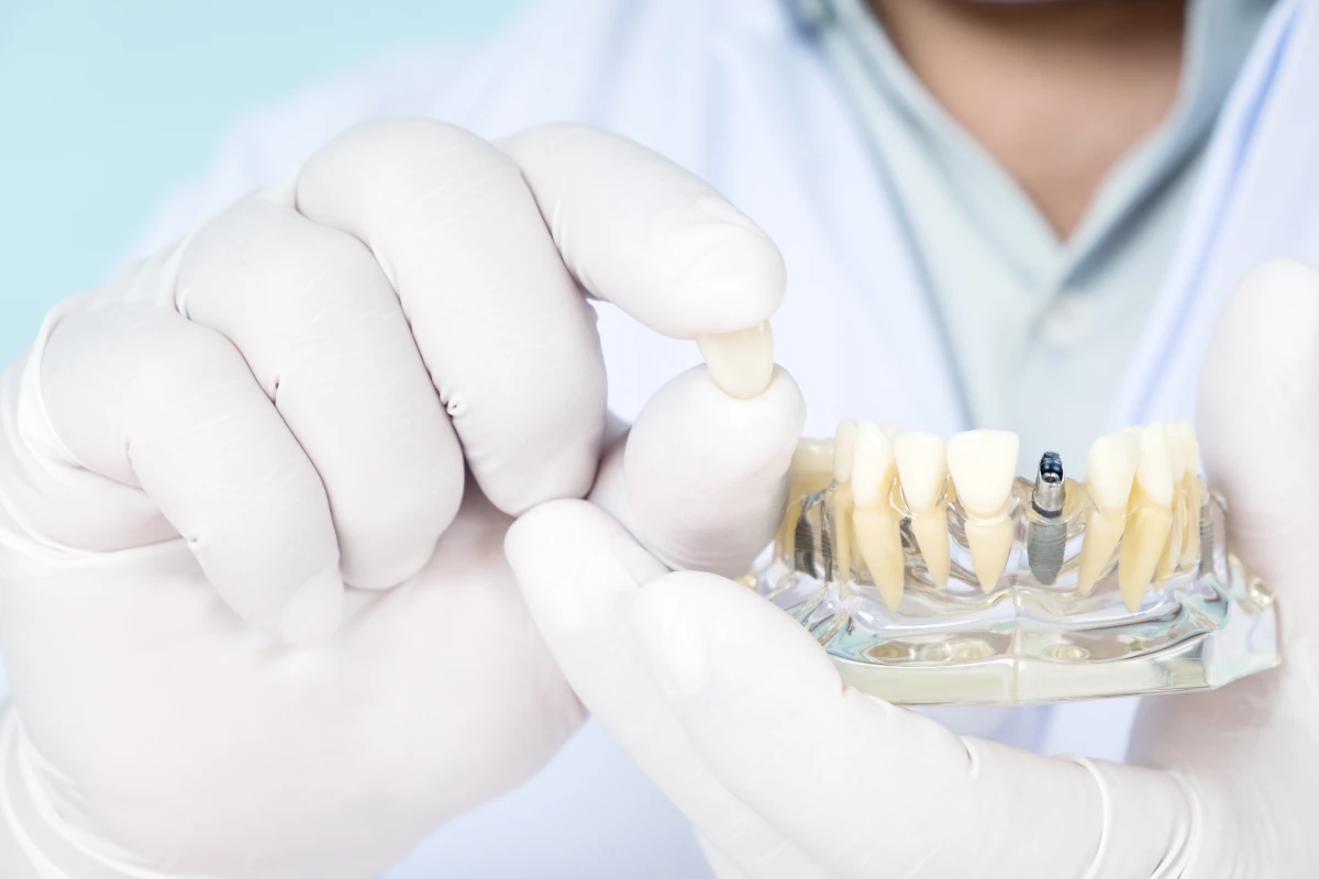 Dentist holding tooth implant and model