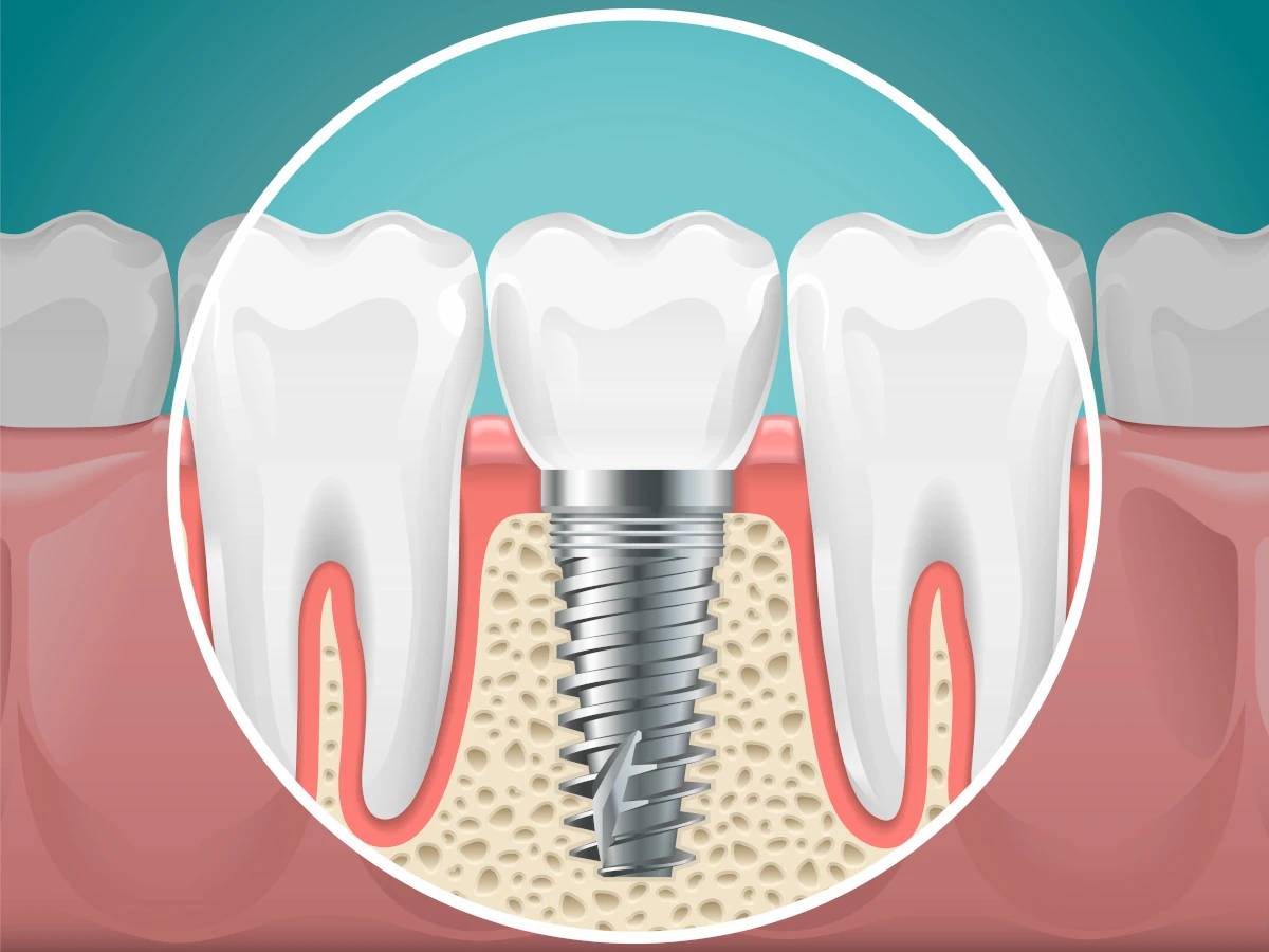 Diagram of tooth implant