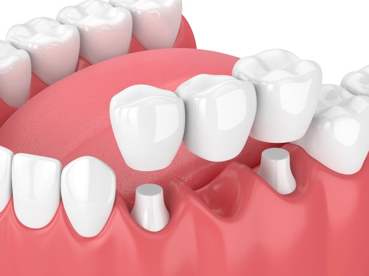 Dental bridge replacing single tooth