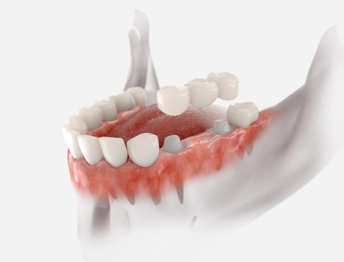 Tooth supported fixed bridge